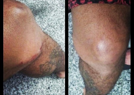 Imagem do joelho esquerdo publicada por Wolverine. Foto: Reprodução/Instagram