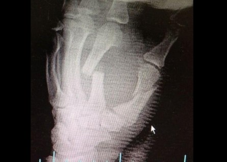 K.Souza divulgou a radiografia de sua mão esquerda. Foto: Twitter/Reprodução