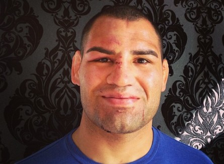 C. Velasquez exibe rosto com pontos após luta contra Cigano. Foto: Instragram/Reprodução