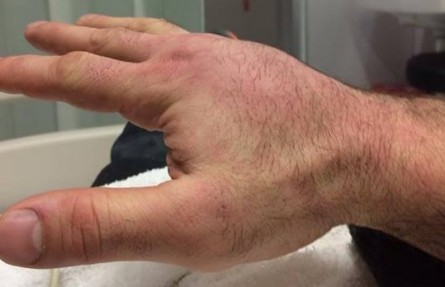 Mão de Napão com inchaço devido à fratura. Foto: Reprodução/Facebook