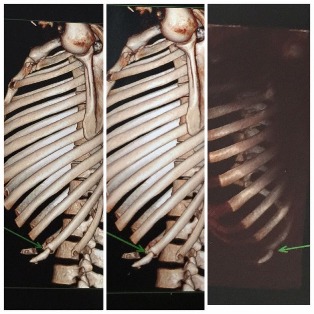 Raixo-X da costela de Aldo mostra local da lesão. Foto: Divulgação