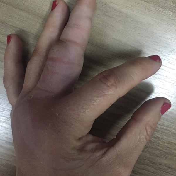 Mão de Claudinha ficou bastante machucada após a luta. Foto: Reprodução