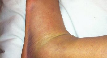 Ross Pearson publica foto do pé incrivelmente inchado, mas descarta fratura