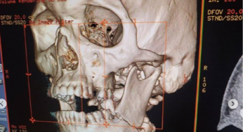 Lian McGeary publica imagem de mandíbula quebrada após derrota no Bellator 220